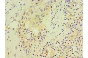 Immunohistochemistry of paraffin-embedded human breast cancer using ABIN7170540 at dilution of 1:100 (Spermidine Synthase anticorps  (AA 1-302))