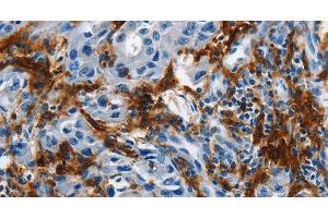 Immunohistochemistry of paraffin-embedded Human lung cancer tissue using IL20RA Polyclonal Antibody at dilution 1:35 (IL20RA anticorps)
