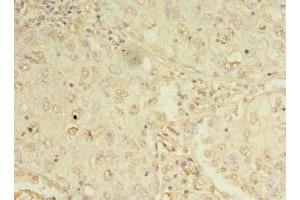 Immunohistochemistry of paraffin-embedded human lung cancer using ABIN7162276 at dilution of 1:100 (ORMDL1 anticorps  (AA 48-100))