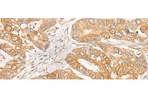 Immunohistochemistry of paraffin-embedded Human gastric cancer tissue using GNB1L Polyclonal Antibody at dilution of 1:35(x200) (GNB1L anticorps)