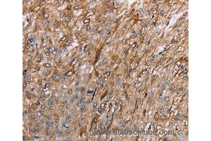 Immunohistochemistry of Human esophagus cancer using GRPR Polyclonal Antibody at dilution of 1:40 (GRPR anticorps)