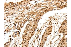The image on the left is immunohistochemistry of paraffin-embedded Human esophagus cancer tissue using ABIN7192627(SPATA20 Antibody) at dilution 1/70, on the right is treated with synthetic peptide. (SPATA2 anticorps)