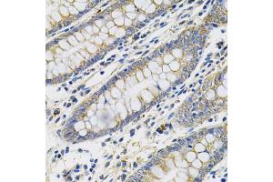Immunohistochemistry of paraffin-embedded human colon using PGF Antibody (ABIN5970864) at dilution of 1/100 (40x lens). (PLGF anticorps)