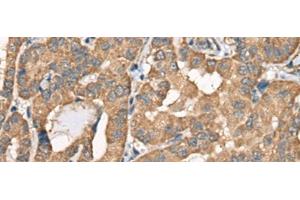 Immunohistochemistry of paraffin-embedded Human thyroid cancer tissue using BCHE Polyclonal Antibody at dilution of 1:40(x200) (Butyrylcholinesterase anticorps)