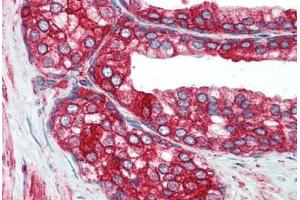 Human Prostate (formalin-fixed, paraffin-embedded) stained with P4HB antibody ABIN396933 at 5 ug/ml followed by biotinylated anti-mouse IgG secondary antibody ABIN481714, alkaline phosphatase-streptavidin and chromogen.
