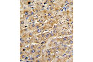Formalin-fixed and paraffin-embedded human hepatocarcinoma with ADAMTS13 Antibody , which was peroxidase-conjugated to the secondary antibody, followed by DAB staining. (ADAMTS13 anticorps  (AA 829-858))