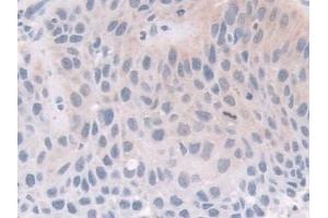 Detection of FKBP4 in Human Lung cancer Tissue using Polyclonal Antibody to FK506 Binding Protein 4 (FKBP4)