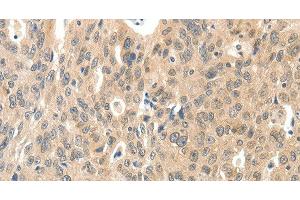 Immunohistochemistry of paraffin-embedded Human ovarian cancer tissue using ROS1 Polyclonal Antibody at dilution 1:40