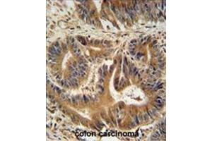 VPS52 antibody (C-term) immunohistochemistry analysis in formalin fixed and paraffin embedded human colon carcinoma followed by peroxidase conjugation of the secondary antibody and DAB staining.