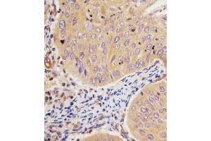 B staining GCLM in human cervical carcinoma tissue sections by Immunohistochemistry (IHC-P - paraformaldehyde-fixed, paraffin-embedded sections). (GCLM anticorps  (C-Term))