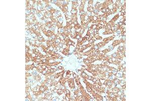 Immunohistochemistry of paraffin-embedded human colon carcinoma using SLC39 antibody (ABIN1682781, ABIN3017803, ABIN3017805 and ABIN6220263) at dilution of 1:100 (40x lens). (SLC39A4 anticorps  (AA 23-327))