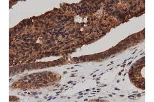 Immunohistochemical staining of paraffin-embedded Adenocarcinoma of Human ovary tissue using anti-DNAJA2 mouse monoclonal antibody. (DNAJA2 anticorps)
