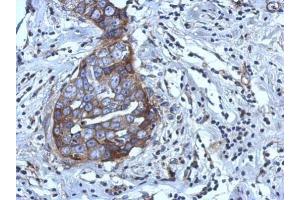 IHC-P Image Immunohistochemical analysis of paraffin-embedded human breast cancer, using RGS4, antibody at 1:500 dilution.