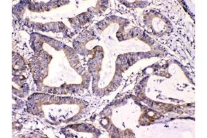 IHC testing of FFPE human intestinal cancer tissue with Calpastatin antibody at 1ug/ml. (Calpastatin anticorps  (AA 275-310))