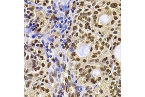 Immunohistochemistry of paraffin-embedded human oophoroma using HIRIP3 antibody (ABIN5974221) at dilution of 1/100 (40x lens). (HIRIP3 anticorps)