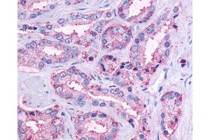 Anti-OR51E1 antibody IHC of human Prostate, Carcinoma. (OR51E1 anticorps  (C-Term))