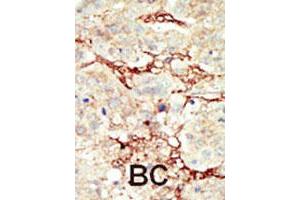 Formalin-fixed and paraffin-embedded human cancer tissue reacted with FGFR3 polyclonal antibody  , which was peroxidase-conjugated to the secondary antibody, followed by DAB staining. (FGFR3 anticorps  (C-Term))
