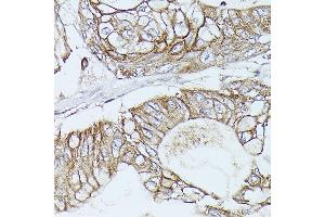 Immunohistochemistry of paraffin-embedded Human pancreatic ductal carcinoma using β-Catenin antibody (ABIN7266137) at dilution of 1:100 (40x lens).