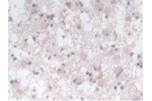 IHC-P analysis of Human Glioma Tissue, with DAB staining. (SNX13 anticorps  (AA 97-284))