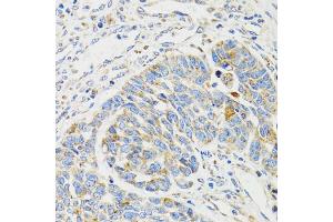 Immunohistochemistry of paraffin-embedded human esophageal cancer using SH2B1 Antibody (ABIN5973245) at dilution of 1/100 (40x lens). (SH2B1 anticorps)