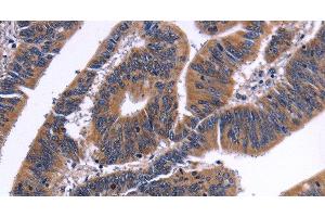 Immunohistochemistry of paraffin-embedded Human colon cancer tissue using NFATC3 Polyclonal Antibody at dilution 1:50