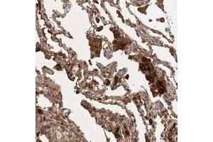 Immunohistochemical staining of human lung with ARL13A polyclonal antibody  shows strong cytoplasmic positivity in macrophages at 1:20-1:50 dilution. (ARL13A anticorps)