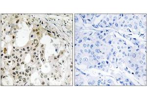 Immunohistochemistry analysis of paraffin-embedded human breast carcinoma tissue using EIF3D antibody. (EIF3D anticorps  (Internal Region))