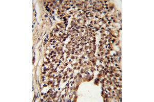 Formalin-fixed and paraffin-embedded human prostate carcinoma reacted with TPI1 Antibody (N-term), which was peroxidase-conjugated to the secondary antibody, followed by DAB staining. (TPI1 anticorps  (N-Term))