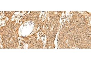 Immunohistochemistry of paraffin-embedded Human esophagus cancer tissue using TIPRL Polyclonal Antibody at dilution of 1:60(x200) (TIPRL anticorps)
