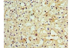 Immunohistochemistry of paraffin-embedded human liver cancer using ABIN7160457 at dilution of 1:100 (MOG anticorps  (AA 30-154))