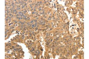 The image on the left is immunohistochemistry of paraffin-embedded Human ovarian cancer tissue using ABIN7130780(PTPRE Antibody) at dilution 1/10, on the right is treated with fusion protein.