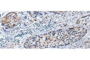 Immunohistochemistry of paraffin-embedded Human cervical cancer tissue using LILRB5 Polyclonal Antibody at dilution of 1:25(x200) (LILRB5 anticorps)