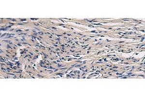 Immunohistochemistry of paraffin-embedded Human brain tissue using CYTIP Polyclonal Antibody at dilution of 1:50(x200) (CYTIP anticorps)