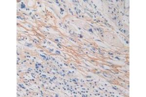 IHC-P analysis of Human Stomach Cancer Tissue, with DAB staining. (Periostin anticorps  (AA 97-230))