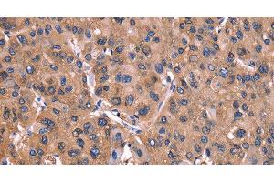 Immunohistochemistry of paraffin-embedded Human liver cancer tissue using ADM2 Polyclonal Antibody at dilution 1:40