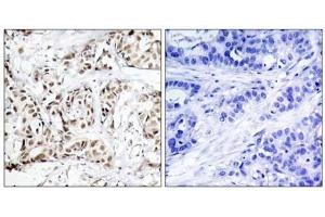 Immunohistochemical analysis of paraffin-embedded human breast carcinoma tissue using SAPK/JNK (phospho-Thr183) antibody (E011249). (SAPK, JNK (pThr183) anticorps)
