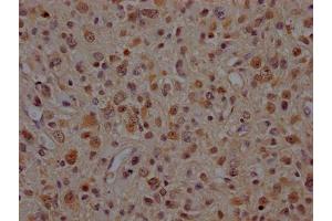 IHC image of ABIN7127867 diluted at 1:100 and staining in paraffin-embedded human glioma cancer performed on a Leica BondTM system.