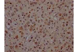 IHC image of ABIN7127867 diluted at 1:100 and staining in paraffin-embedded human glioma cancer performed on a Leica BondTM system. (Recombinant VCP anticorps)