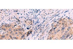 Immunohistochemistry of paraffin-embedded Human cervical cancer tissue using KCNN1 Polyclonal Antibody at dilution of 1:55(x200) (KCNN1 anticorps)