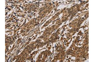 The image on the left is immunohistochemistry of paraffin-embedded Human gastric cancer tissue using ABIN7190293(CLEC2A Antibody) at dilution 1/20, on the right is treated with synthetic peptide. (CLEC2A anticorps)