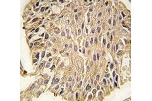 IHC analysis of FFPE human lung carcinoma tissue stained with ALDOA antibody