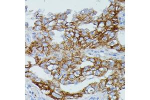 Immunohistochemistry of paraffin-embedded human lung cancer using FCGR1B antibody (ABIN7267161) at dilution of 1:100 (40x lens). (FCGR1B anticorps)