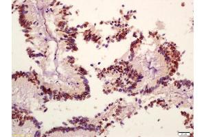 Formalin-fixed and paraffin embedded human colon carcinoma labeled with Anti-phospho-PI3 Kinase p110 beta(Ser1070) Polyclonal Antibody, Unconjugated (ABIN872304) at 1:200 followed by conjugation to the secondary antibody and DAB staining