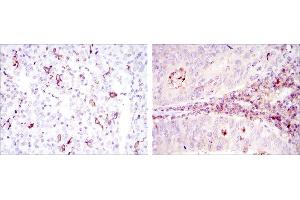 Immunohistochemical analysis of paraffin-embedded cervical cancer tissues (left) and colon cancer tissues (right) using CD1A mouse mAb with DAB staining. (CD1a anticorps)