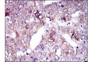 Immunohistochemical analysis of paraffin-embedded liver cancer tissues using SLC27A5 mouse mAb with DAB staining.