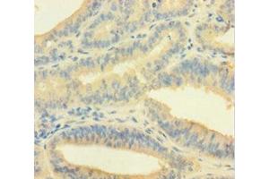 Immunohistochemistry of paraffin-embedded human endometrial cancer using ABIN7148691 at dilution of 1:100 (Crossover junction endonuclease EME1 (EME1) (AA 1-583) anticorps)