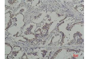 Immunohistochemical analysis of paraffin-embedded Human Breast Caricnoma using Phosphotyrosine Mouse mAb diluted at 1:200. (Phosphotyrosine anticorps)
