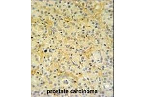 DAZ Antibody (C-term) (ABIN653931 and ABIN2843163) IHC analysis in formalin fixed and paraffin embedded prostate carcinoma followed by peroxidase conjugation of the secondary antibody and DAB staining. (DAZAP2 anticorps  (C-Term))