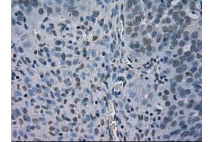 Immunohistochemical staining of paraffin-embedded Adenocarcinoma of breast tissue using anti-BUB1B mouse monoclonal antibody. (BUB1B anticorps)