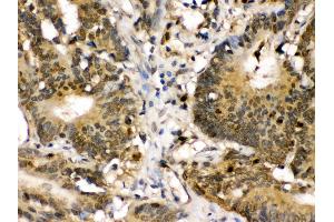 Anti- MEK3 Picoband antibody, IHC(P) IHC(P): Human Intestinal Cancer Tissue